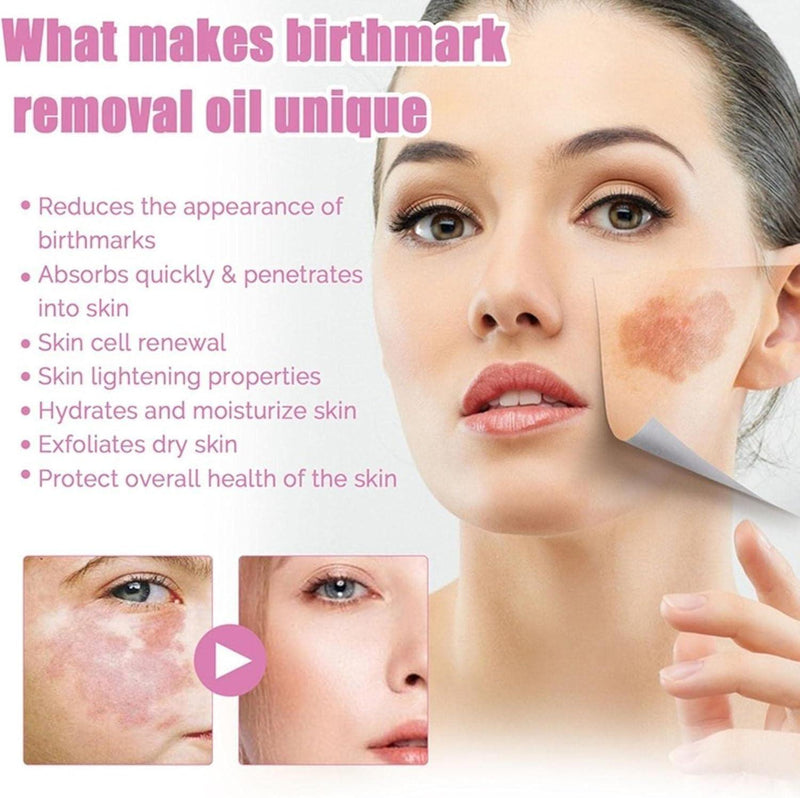 Birthmark Removal Oil 10ML (Pack of 2) -  Store_name 